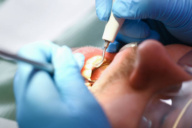 Best Dentist for Tooth Abscess  in Delhi, CA